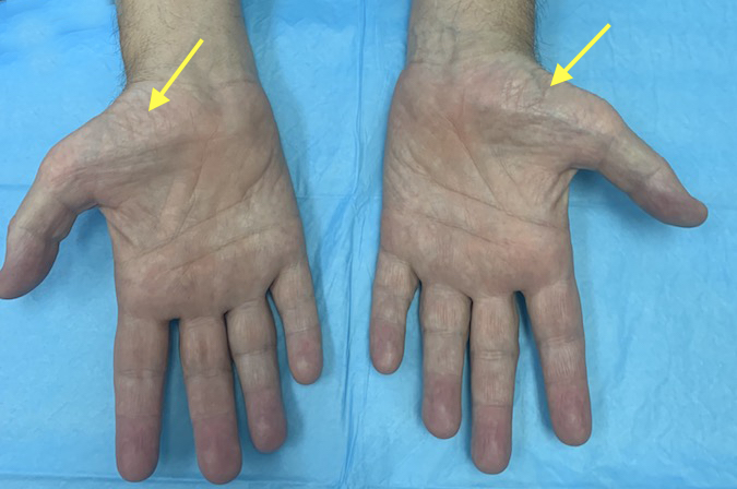 Bilateral hands (palmar view) of a middle aged male with advanced CMT disease.  Note the severe thenar atrophy (arrows).