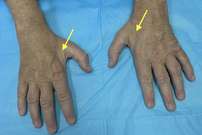 Bilateral hands of a middle aged male with advanced CMT disease.  Note the severe intrinsic atrophy (arrows).