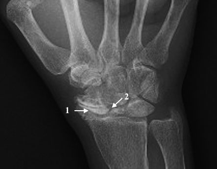SNAC Wrist with arthritic radioscaphoid joint (1) and S-L gap (2)