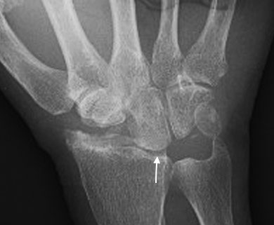 SNAC Wrist after proximal row carpectomy (PRC) Note intact radiocapitate joint space (arrow)