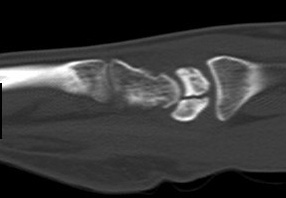 Kienbock's Disease (AVN of Lunate) secondary to fracture which is rare.