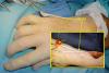Use both EDM slips for this opponensplasty.  If one slip is left attached to the finger extensor mechanism, the finger will extend but the thumb opposition WILL BE LOST.