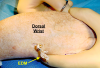 A tendon passer has been inserted at the carpal tunnel incision, through the subcutaneous tissues to the dorsal ulnar wrist.  The EDM has been placed in the jaws of the tendon passer.  The EDM will be pulled through the subcutaneous tunnel.