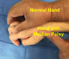 Note thumb opposition in normal hand and the inability to separate the thumb from the palm in patient with the median nerve palsy.