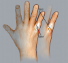 The drawing shows the EDC, EDM and sagittal bands. The EDM is release from the EDC and sagittal band by cutting a proximal based triangular segment of tendon out of the extensor hood. After release of both EDM slips the sagittal band is repaired to the EDC.