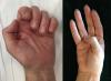Thenar atrophy where attempted opposition leads to thumb adducting across the palm.