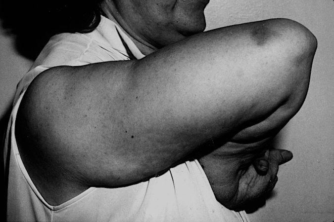 Severe neglected right upper extremity deformity after a CVA.