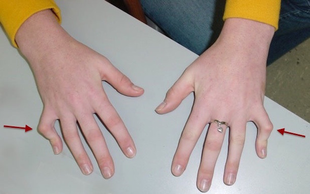 Bilateral Fifth Finger Camptodactyly