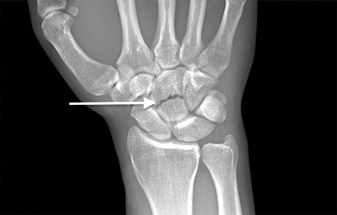 Transverse fracture (arrow) of the body of the capitate AP view