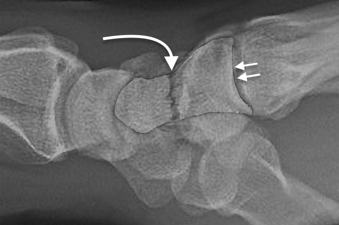Transverse fracture (curved arrow) of the body of the capitate lateral view with double arrow on capitate outline