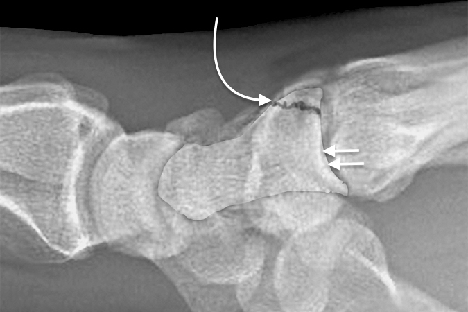 Fracture (curved arrow) of the dorsal lip of the capitate lateral view with double arrow on capitate outline
