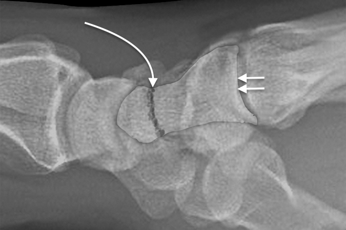 Fracture (curved arrow) of the neck of the capitate lateral view with double arrow on capitate outline.  Capitate head at risk for AVN with this fracture