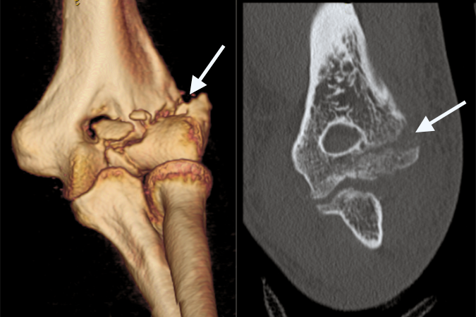 Left adult capitellar CT with arrows at fracture line.