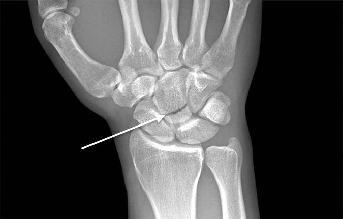 Transverse fracture (arrow) of the neck of the capitate AP view