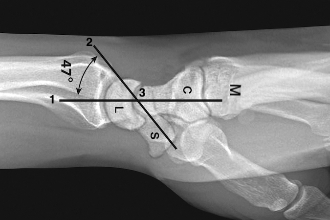 On a normal neutral rotation lateral, the horizontal axis of the radius, lunate, capitate, and metacarpals is a straight line (1).  A line (2) the longitudinal axis of the scaphoid crosses line (1) at point (3).  The average normal angle between these lines is 47° (range 30-60°).  Angles outside this range suggest carpal instability (DISI >60°; VISI <30°).