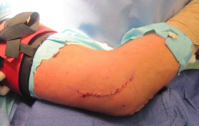 Carposcope Ulnar Neurolysis- Incision closed