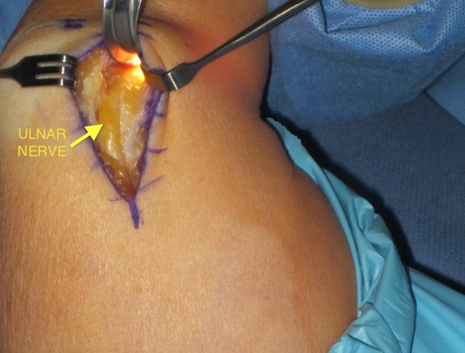 Carposcope Ulnar Neurolysis- Nerve exposed and scope being placed in subcutaneous tissue superficial to fascia