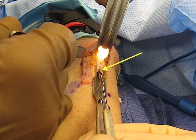 Carposcope Ulnar Neurolysis- Guide separating fascia from underlying ulnar nerve while forked knife (arrow) begins to cut fascia