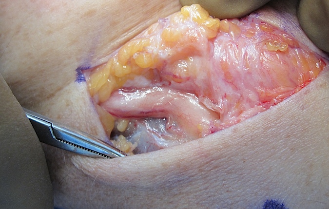 Carposcope Ulnar Neurolysis- Tortuous nerve