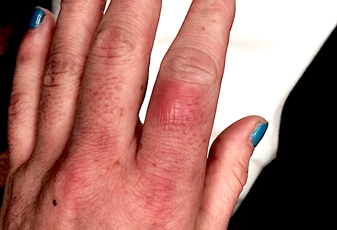 Cellulitis Left Index Finger