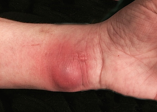 Cellulitis Left Volar Wrist with abscess