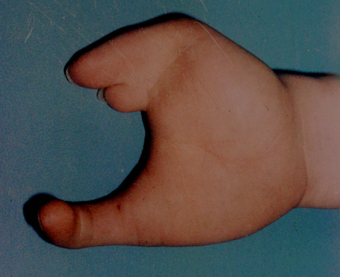 Cleft Hand, symbrachydactyly type with wide "U" shape and syndactyly of the radial digits (thumb and index) and camptodactyly of the ulnar digit