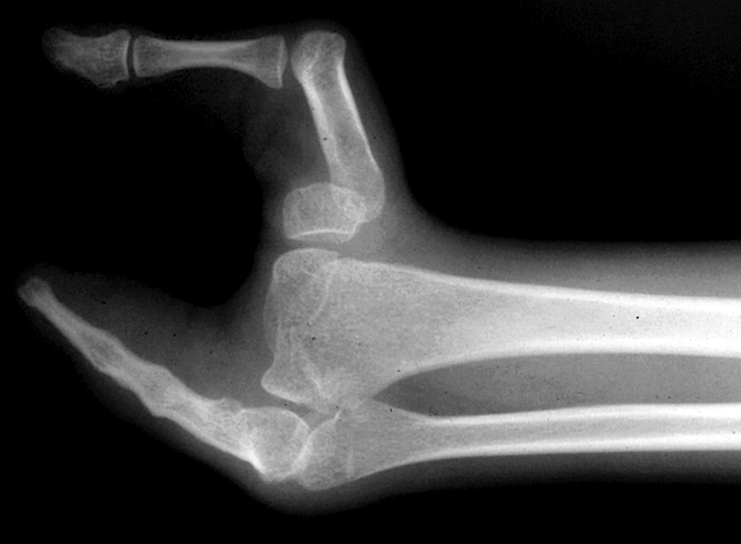Cleft Hand X-Ray with central phalangeal, metacarpal and carpal insufficiencies and congenital fifth finger fusions.