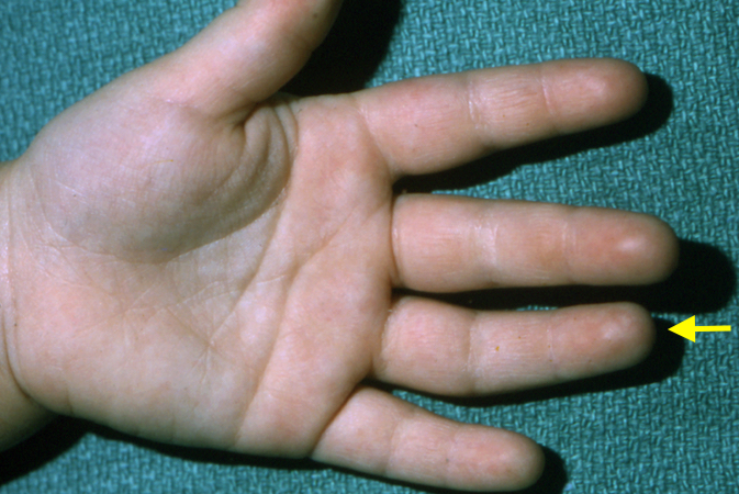 Ring finger clinodactyly (arrow).