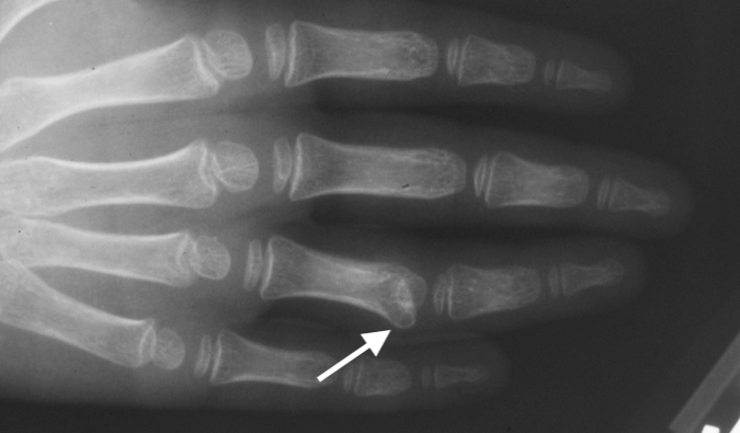 Acquired ring finger clinodactyly secondary to osteochondroma (arrow)