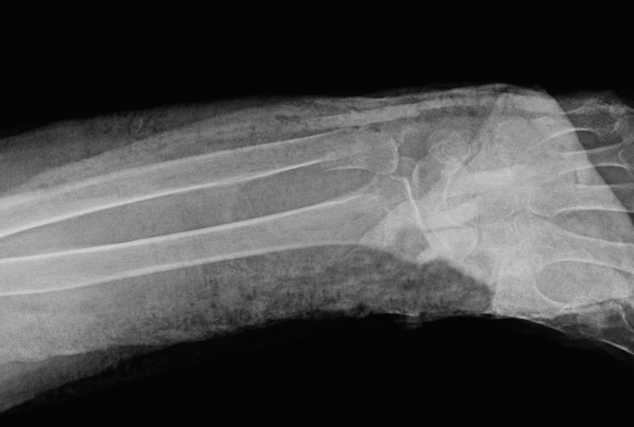 Reduced classic Colles' Fracture AP view with near anatomic alignment