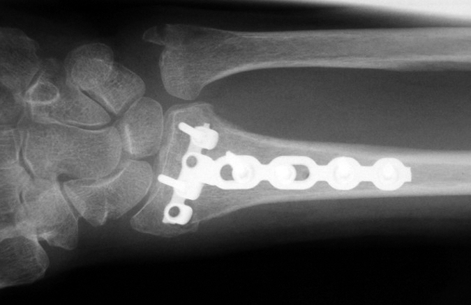 Internally fixed distal radius fracture AP view