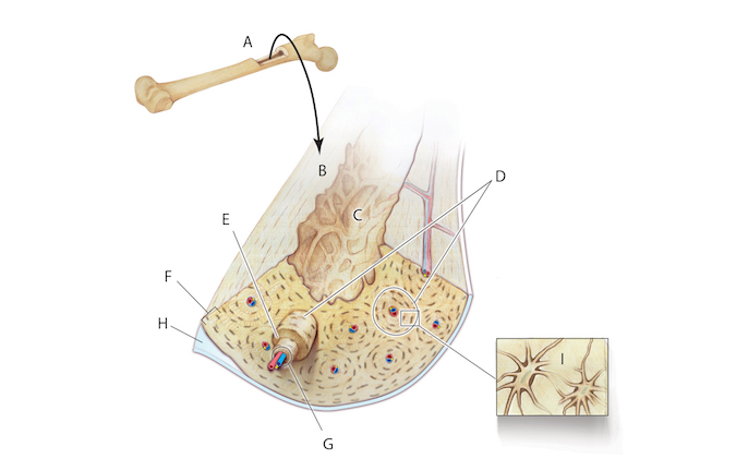 Histology of normal bone: A = Long bone (femur); B = Harvested section; C = Medullary cavity; D = Osteons; E = Concentric lamellae; F = Circumferential lamellae; G = Central canal with artery (a), vein(v), nerve(n); H = Periosteum; I = Lacunae with osteocytes