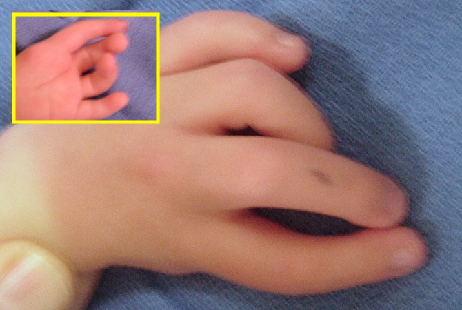Left Hypoplastic Thumb Type 5 for pollicization