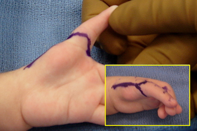 Left Hypoplastic Thumb Type 5 pollicization skin incisions (palmar flap not used)