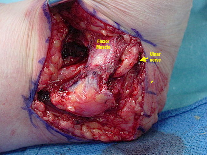 Cubital Tunnel Syndrome - Submuscular Transposition