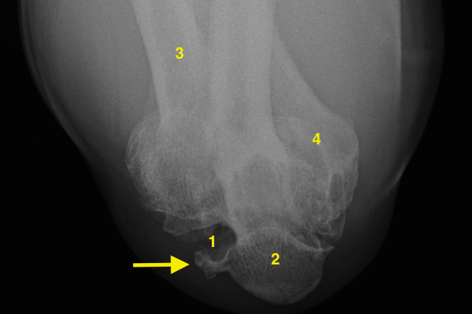 Cubital Tunnel view with arthritis. 1. Cubital tunnel (Olecranon Groove); 2. Olecranon; 3. Proximal Radius; 4. Distal Humerus Arrow - osteophyte compressing ulnar nerve