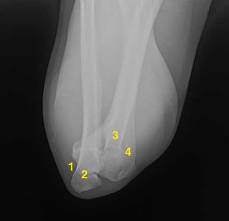 Cubital Tunnel view with no arthritis. 1.Cubital tunnel (Olecranon Groove); 2.Olecranon; 3.Proximal Radius; 4.Distal Humerus