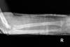 AP  X-ray of mid-forearm right double bone forearm fractures.  Anatomic reduction with fracture lines not apparent
