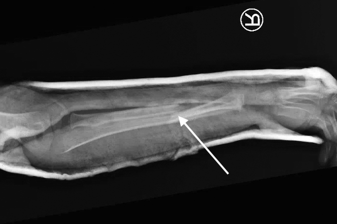 Lateral  X-ray of mid-forearm right double bone forearm fracture with lost reduction (arrow). Note 100% displaced with shortening.