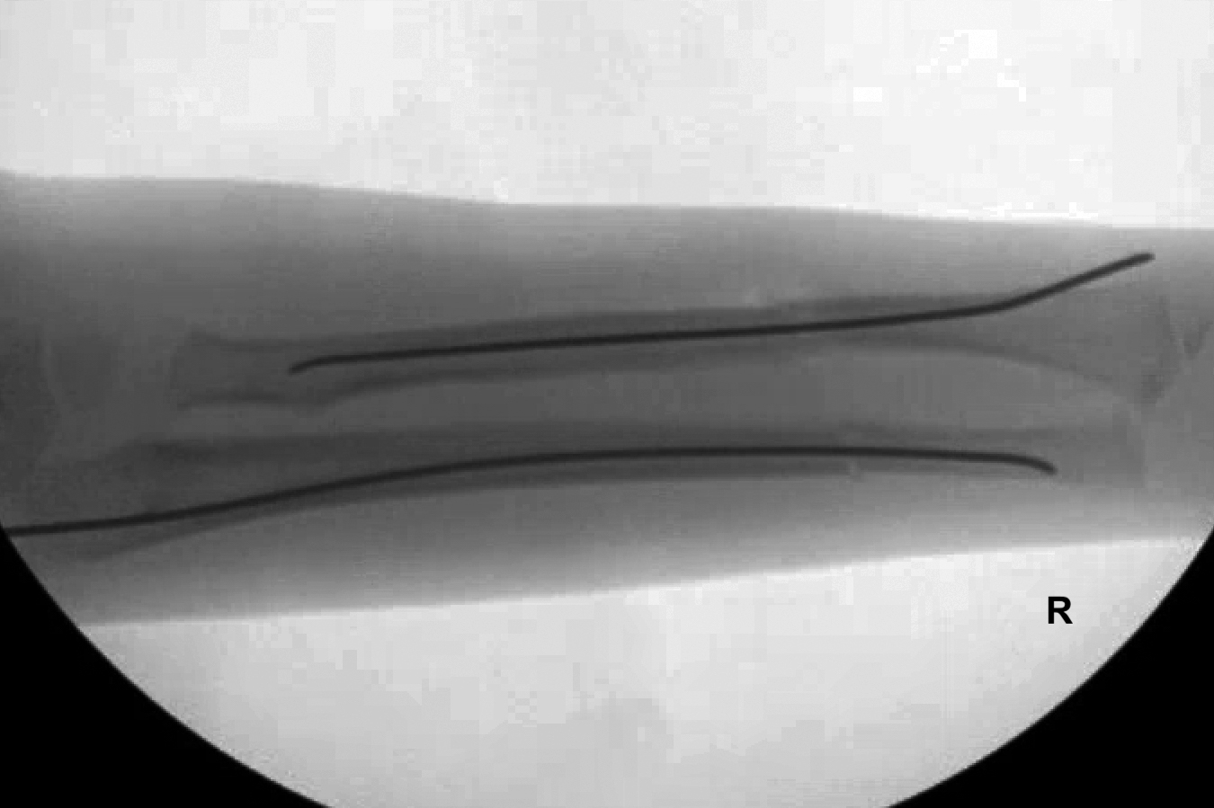 AP  X-ray of mid-forearm right double bone forearm fractures.  Anatomic reduction with fracture lines not apparent