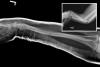 Left severely angulated double bone forearm fractures after initial closed reduction and splinting.