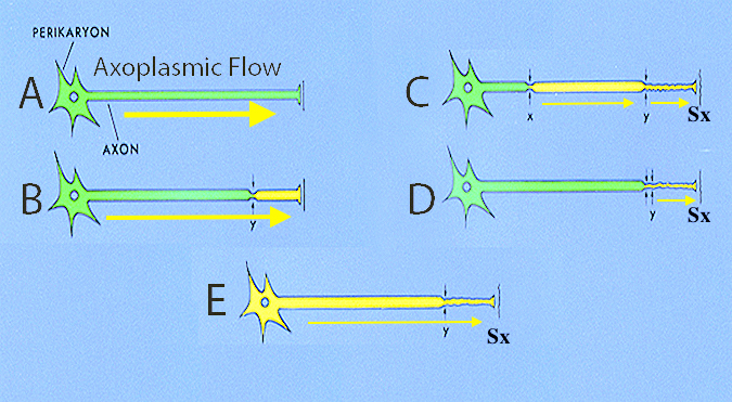 A – Normal perikaryon and axon with normal flow (large horizontal arrow), normal function and no symptoms (paresthesias). B. - Normal perikaryon and axon with slightly impaired flow (horizontal arrow), normal function and no symptoms (paresthesias). C. - Normal perikaryon and abnormal axon with moderately impaired flow (small thin arrow) at two levels (X&Y), with abnormal function and symptoms (Sx) representing classical Double Crush Syndrome. D. - Normal perikaryon and abnormal axon flow (small thin arrow)