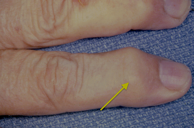 OA involving the DIP joint, Herberden's Nodule (arrow).