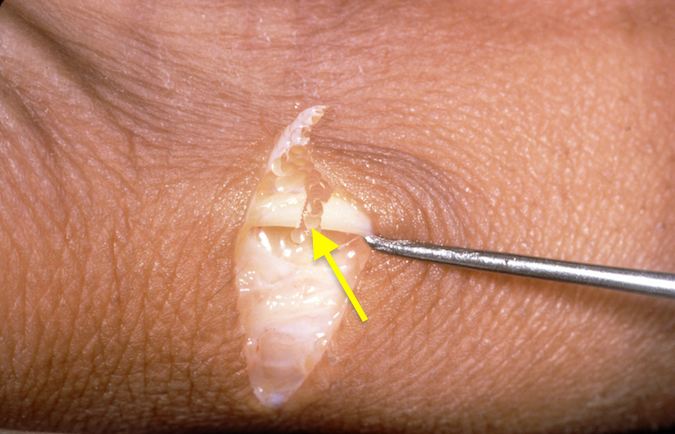 Dorsal radial sensory nerve laceration (arrow) after trimming of the nerve endings.