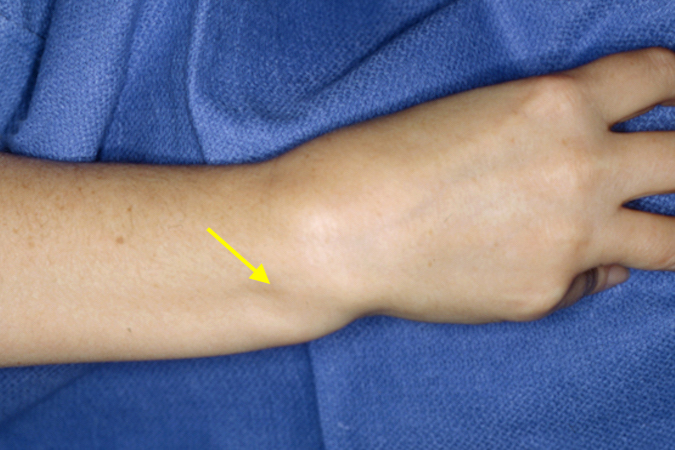 Classic deformity (arrow) associated with a volar DRUJ dislocation.