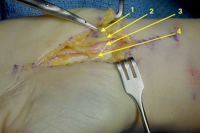 Guyon's canal opened with superficial part of ganglion exposed (1); ulnar nerve (2); ulnar artery with vena comitans (3); cut edge of the transverse carpal ligament.