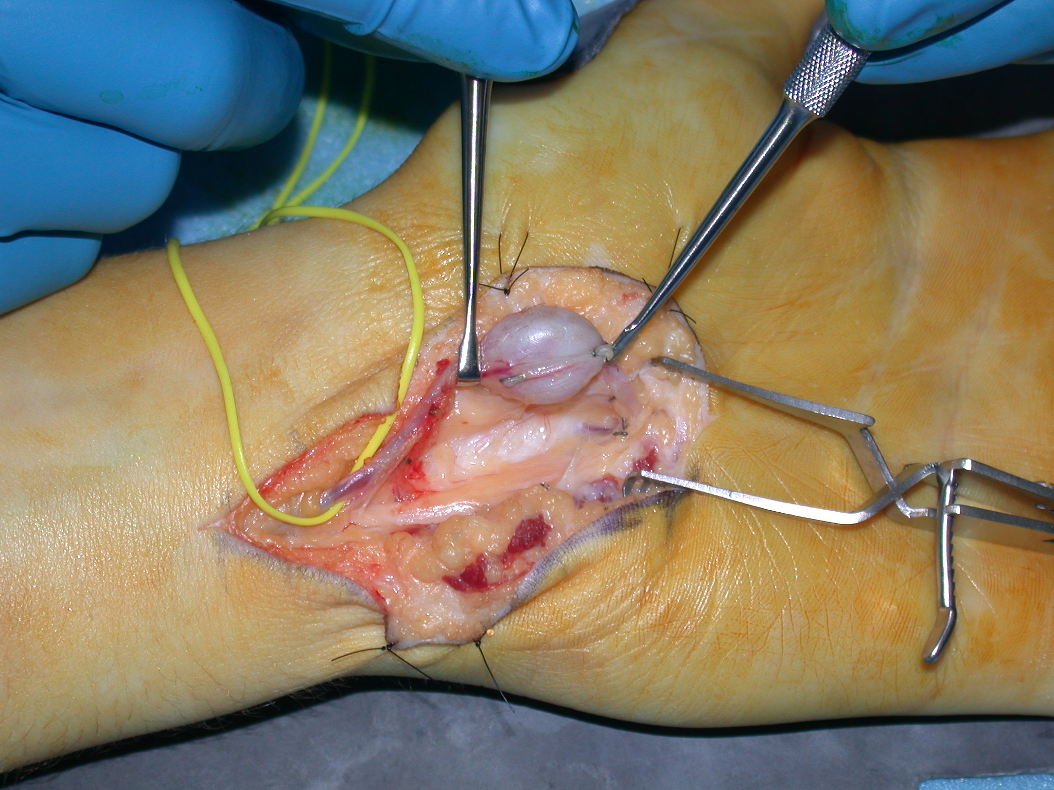 Ulnar Artery Aneurysm