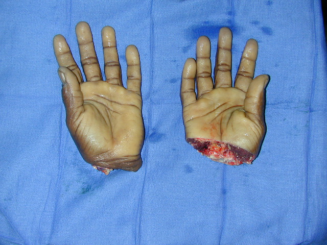 Bilateral simultaneous hand amputations from an industrial metal press accident