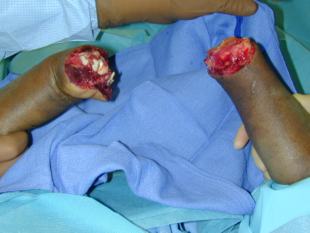 Bilateral simultaneous hand amputations proximal stumps from an industrial accident