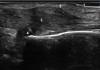 Longitudinal ultrasound image of first extensor compartment in patient with DeQuervain’s Tenosynovitis: 1=skin; 2=extensor compartment thicken fascial sheath; 3=degenerated enlarged extensor tendons with intratendinous fluid; 4=distal radius